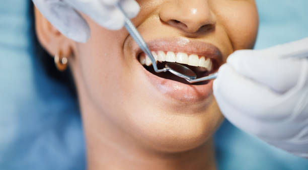 Best Emergency Wisdom Tooth Extraction in Pendleton, IN